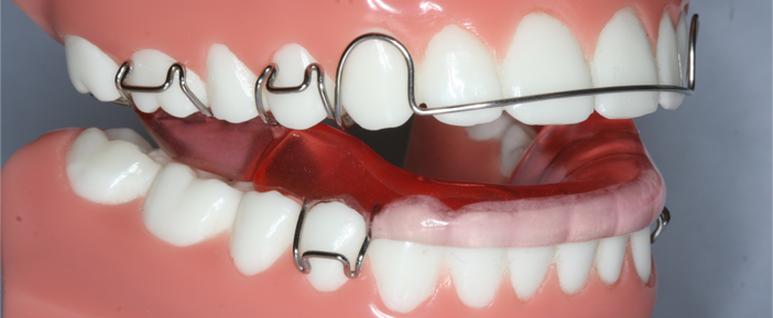 مراحل انجام ارتودنسی دندان